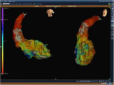 Radiosurgery in Treatment of Ventricular Tachycardia – Initial Experience Within the Polish SMART-VT Trial